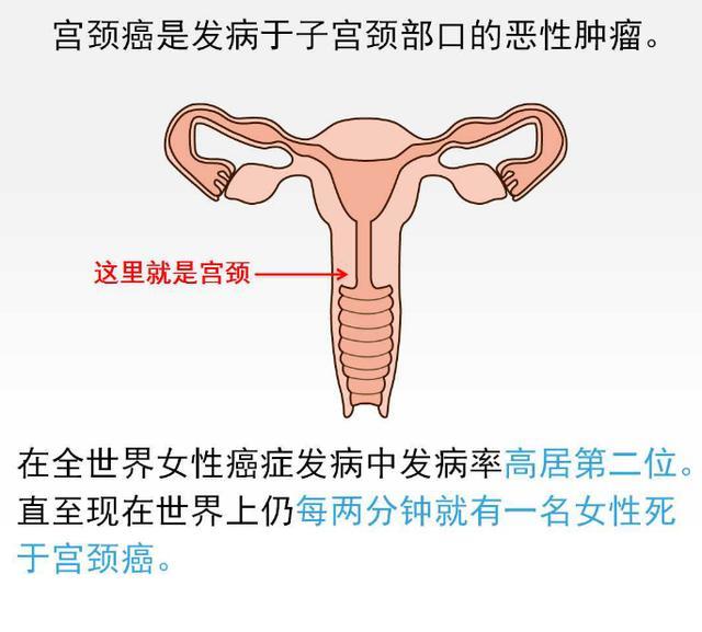 17岁女孩宫颈癌晚期，警示社会，引发反思